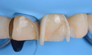 Composite Veneers Price