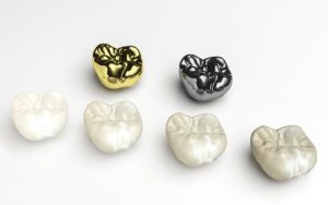 Dental Cap Cost