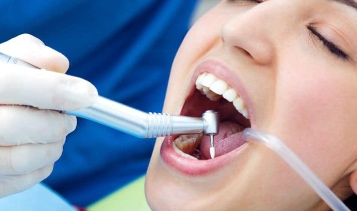How Much Do Fillings Cost?