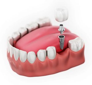 tooth implant near me