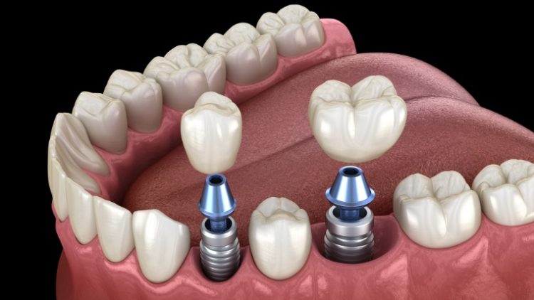 Tooth Implant Near Me