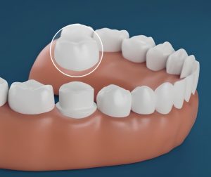 Dental Crown Cost